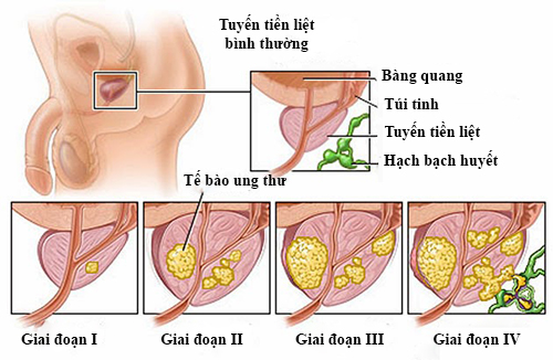 Các triệu chứng của bệnh trở nên dễ nhận biết ở những giai đoạn muộn